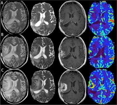 Advanced Imaging Techniques for Differentiating Pseudoprogression and Tumor Recurrence After Immunotherapy for Glioblastoma